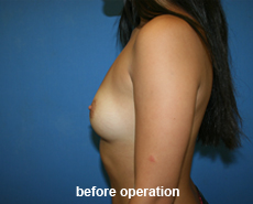 plastic-surgery-breast-augmentation